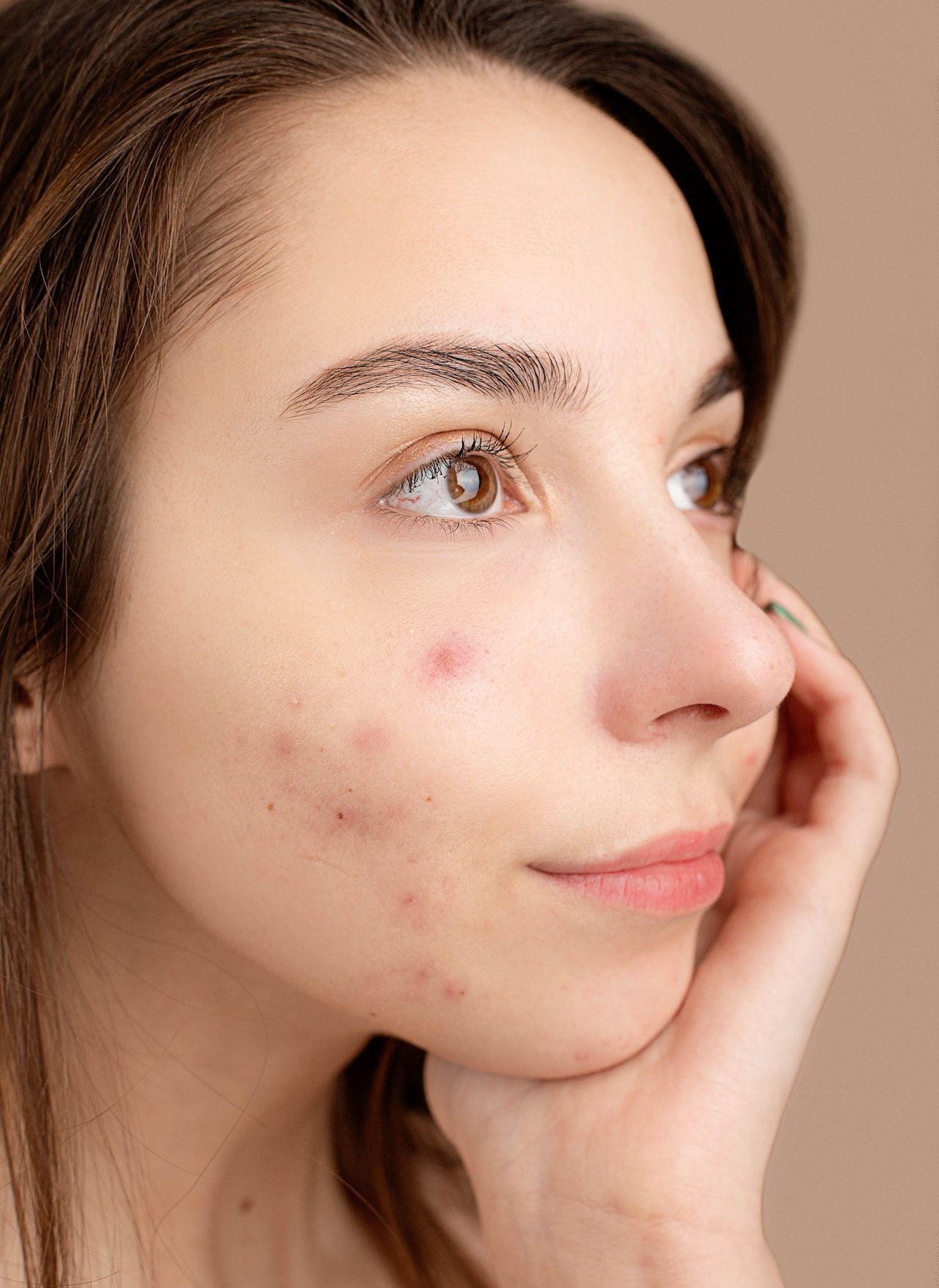 Isotretinoin (Roaccutane)